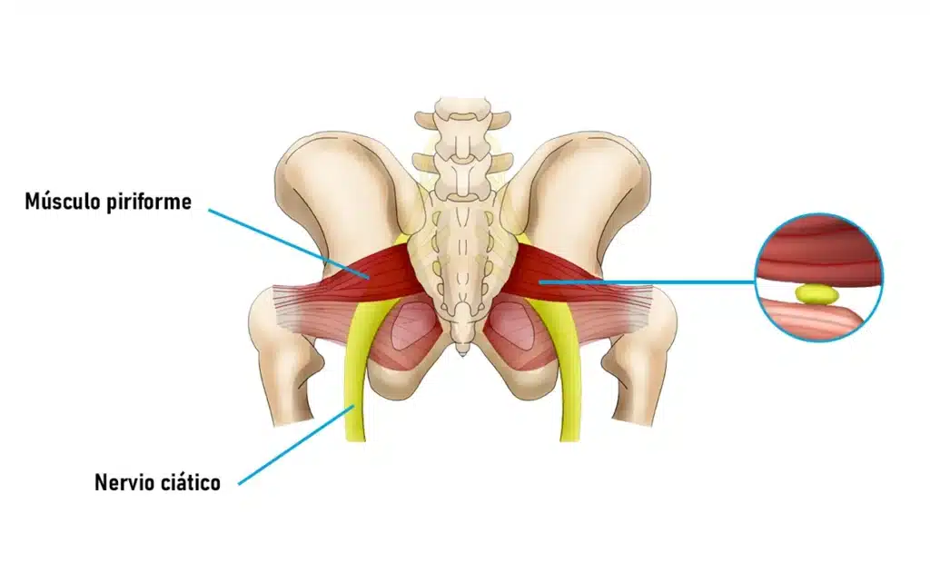 Imagen representativa que muestra cómo y porqué se produce el síndrome piramidal